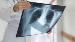 Pneumologistas alertam para importância do diagnóstico precoce na DPOC