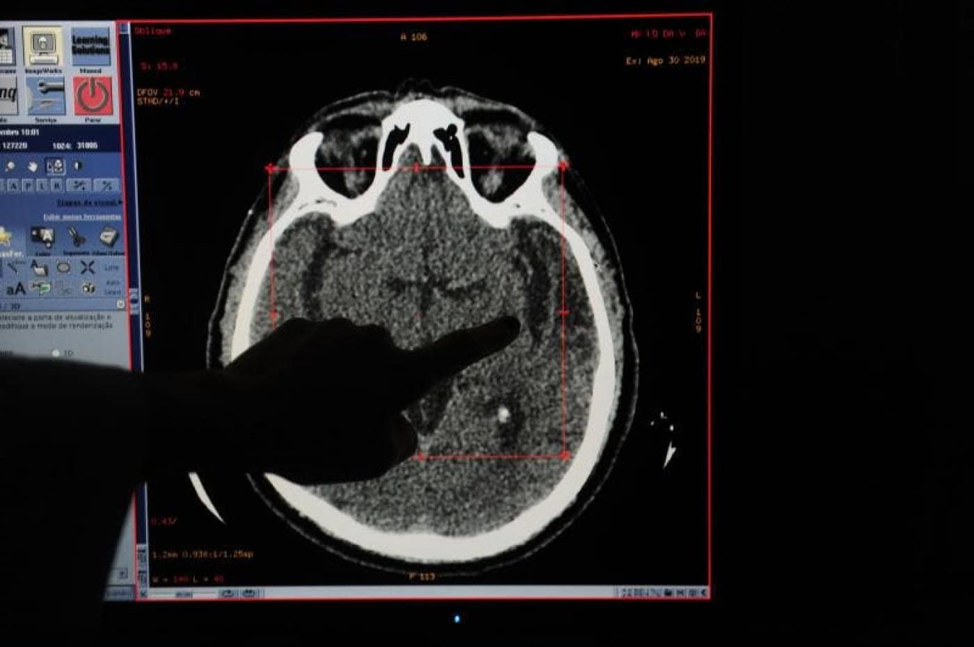 Consultas atrasadas e tratamentos a meio gás aumentam risco de AVC