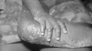 Portugal regista 14 casos de infeção pelo vírus Monkeypox