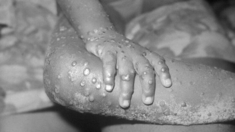Portugal regista 14 casos de infeção pelo vírus Monkeypox