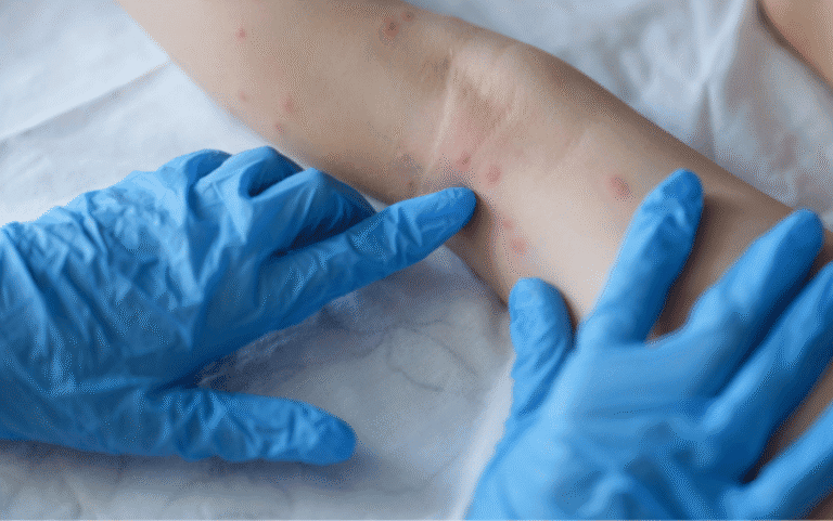 Portugal contabiliza 96 casos confirmados de varíola dos macacos