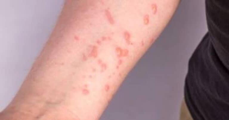 Mpox: Suécia anuncia deteção do primeiro caso do vírus fora de África&nbsp;