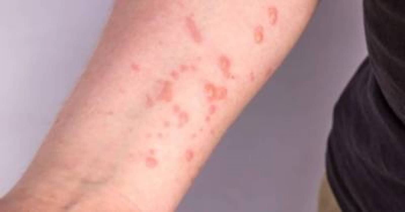 Mpox: Suécia anuncia deteção do primeiro caso do vírus fora de África