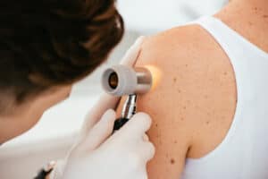 ULS Braga promove rastreios gratuitos de cancro de pele no Dia Europeu do Melanoma