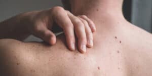 LPCC Braga promove palestra sobre cancro da pele